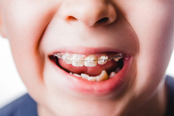 Orthodontie enfant