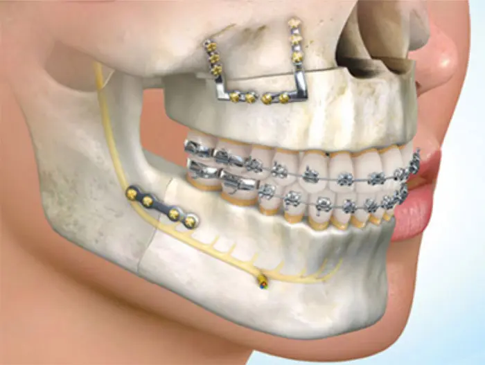 Orthodontie chirurgicale