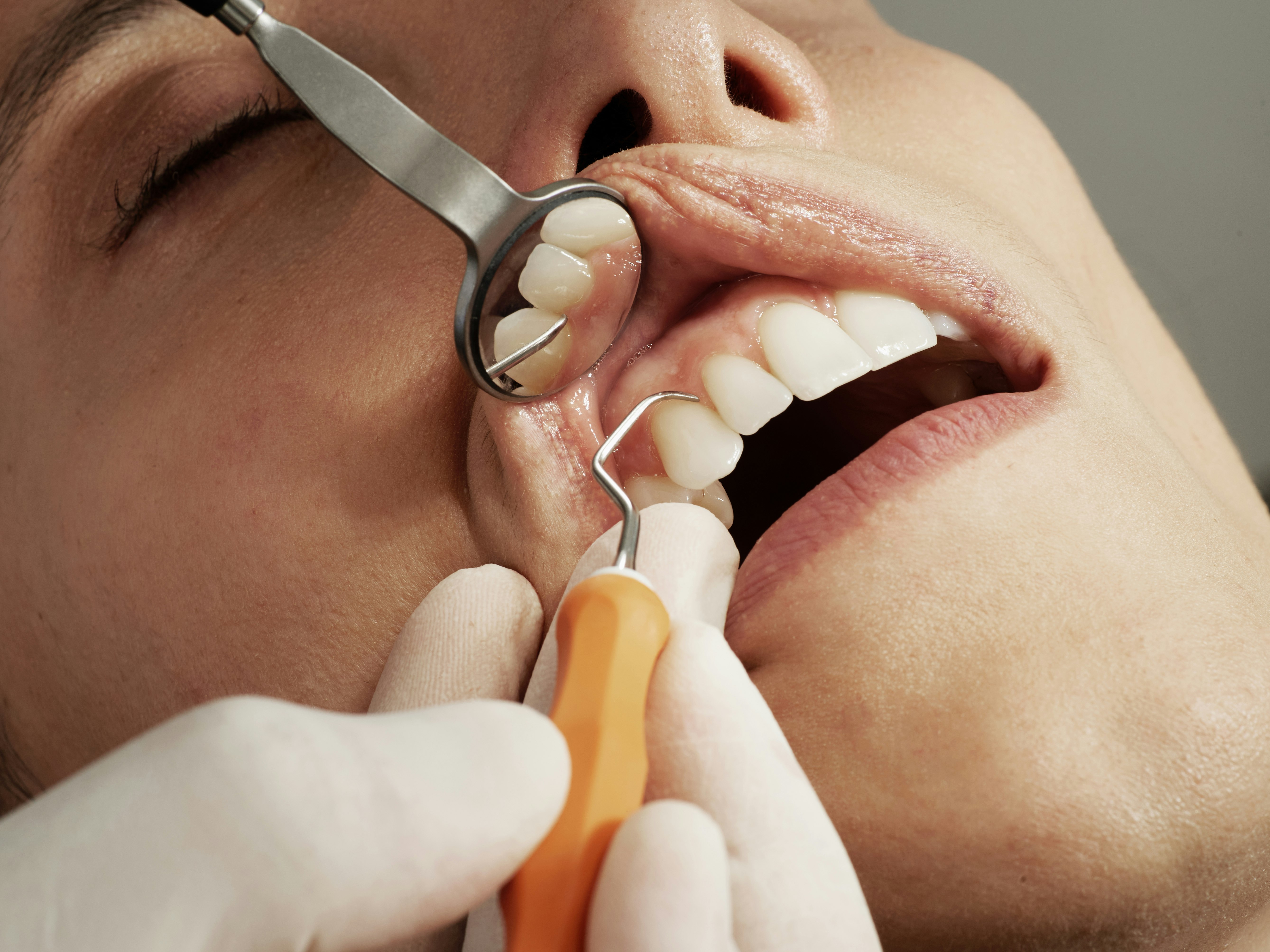 Orthodontie pour adultes : Il n'est jamais trop tard pour un sourire parfait